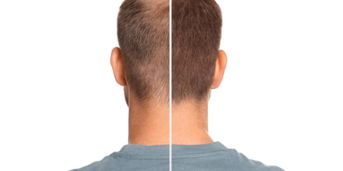 Transform Your Look with Smart FUE Hair Transplants