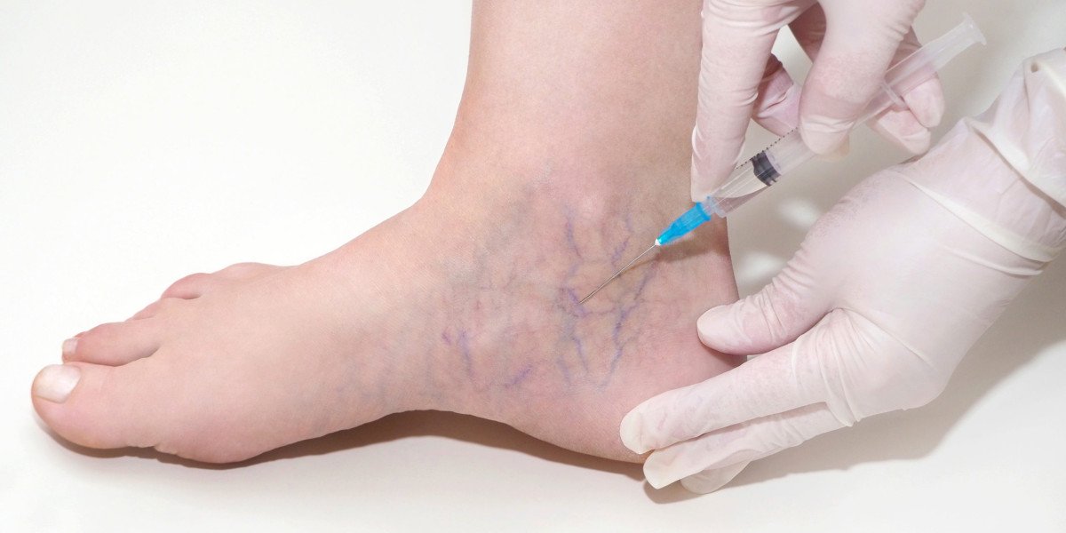 Sclerotherapy: A Comprehensive Guide to Treating Varicose and Spider Veins