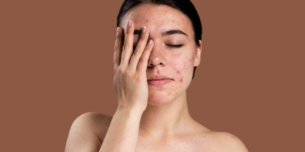 Get Rid of Pimples With Homeopathy. Consult a Homeopathic Doctor in India