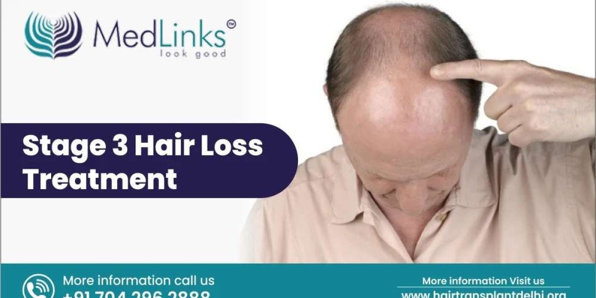 Stage 3 Hair Loss Treatment