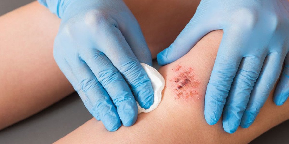 Global Wound Healing Market | Industry Analysis, Trends & Forecast to 2032