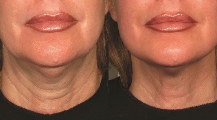 Is Ultherapy Treatment Ideal for Skin Tightening? 4 Things You Must Know - PR Business Wires